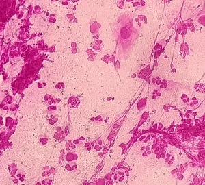 MUESTRA HIST. DIPLOCOCCUS GONORRHOEAE SIWAY UN