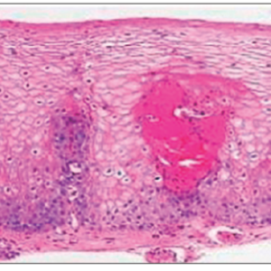 MUESTRA HIST. DE ESOFAGO SIWAY UN